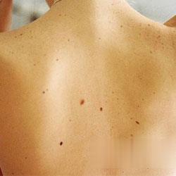 身体雀斑